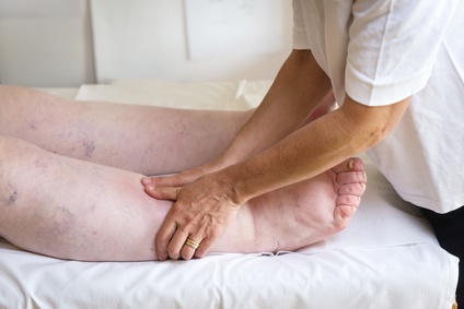 Lee más sobre el artículo ¿Conoces acerca del linfedema?