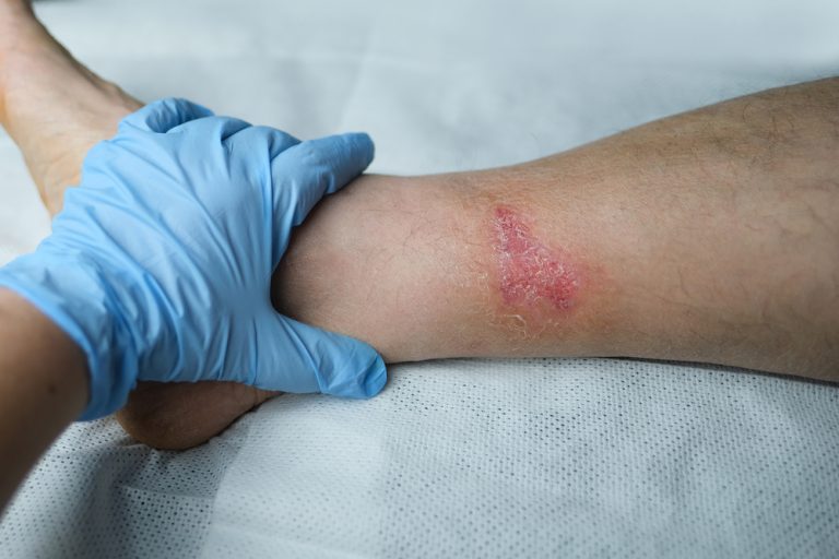 Lee más sobre el artículo Cómo prevenir lesiones por presión
